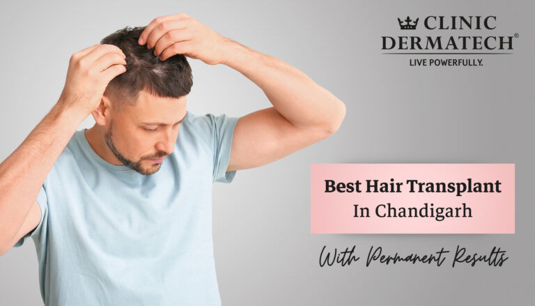 hair transplant in chandigarh 768x439